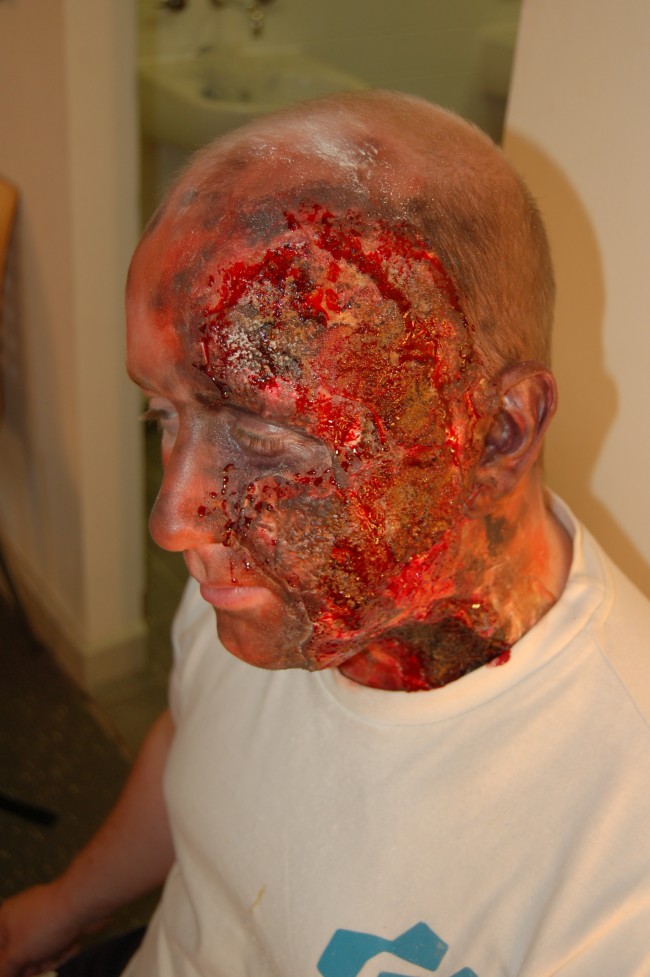 Face burns